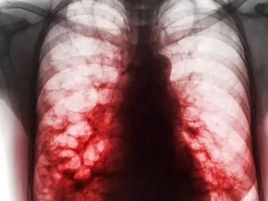 Bronchiectasis versus COPD: What’s the Difference?